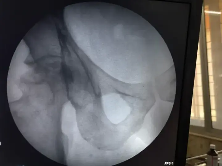 AVN — deformed femoral head
