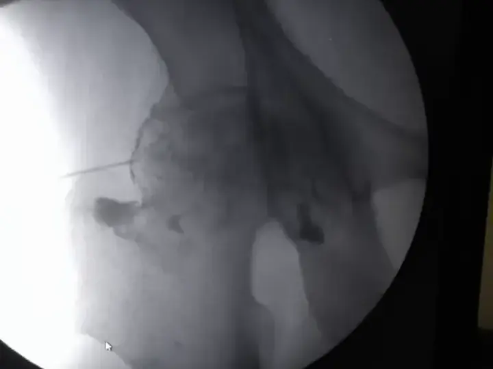 Ozone injection in hip joint