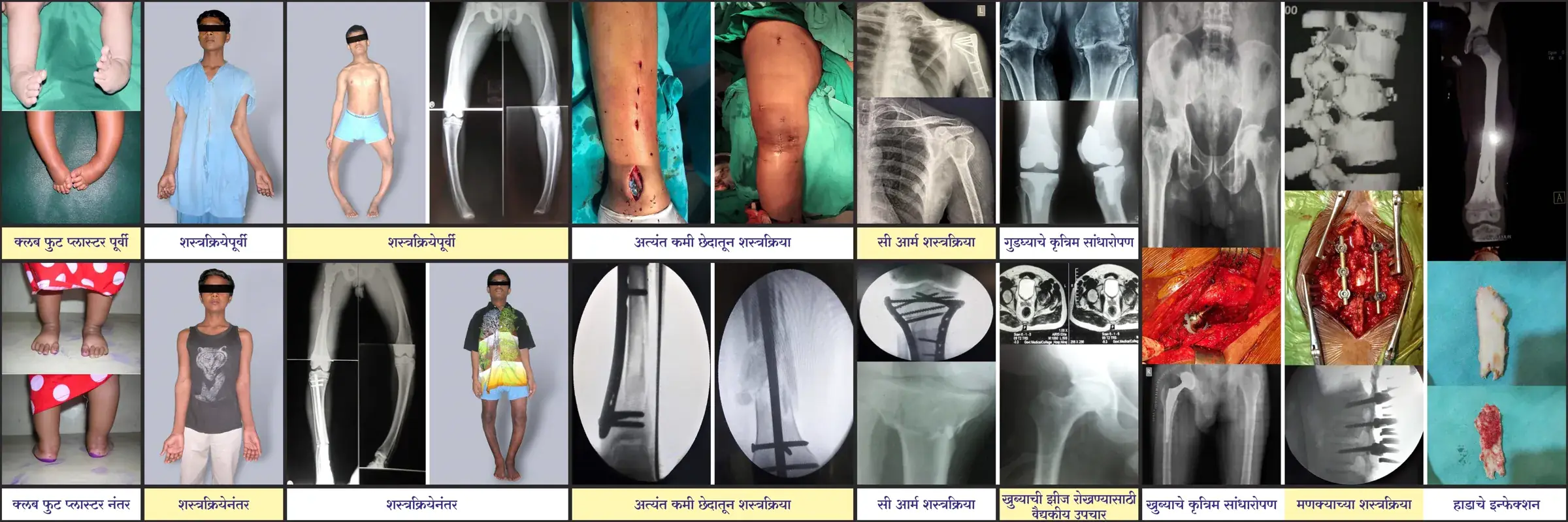 Before and after collage — clubfoot correction, deformity correction, minimally invasive surgery, joint replacement and spine surgery cases