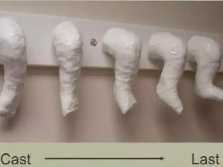 Ponseti plaster correction