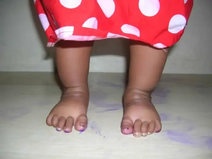 Clubfoot correction