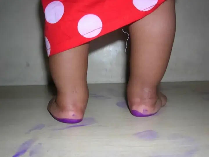 Clubfoot correction