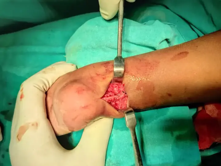 TA lengthening in older children