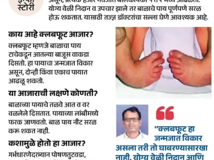 Clubfoot treatment