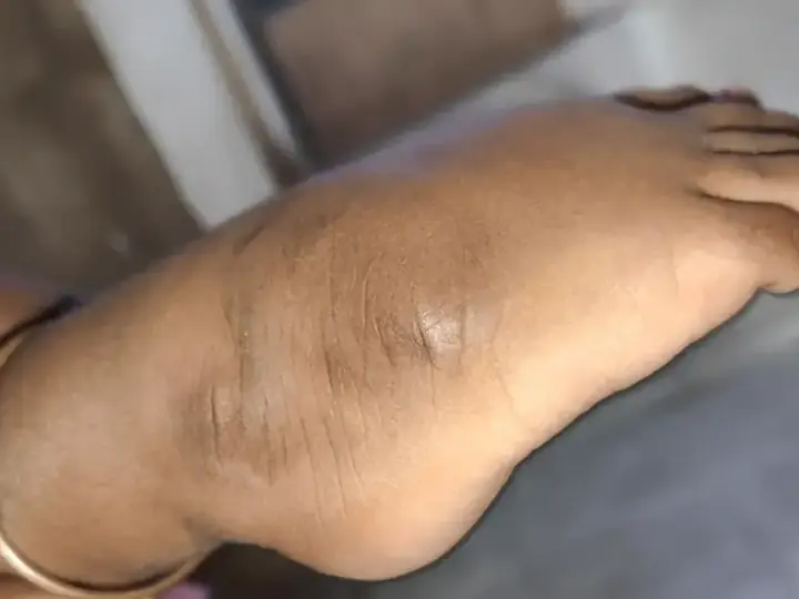 Clubfoot — TA transfer case