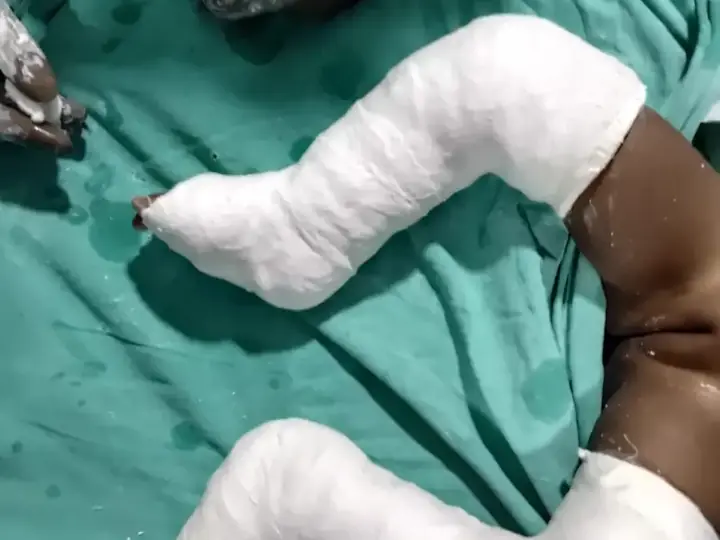 Clubfoot — TA transfer case