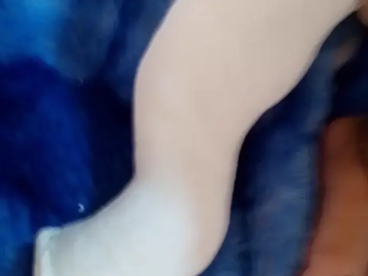 Clubfoot correction — before and after