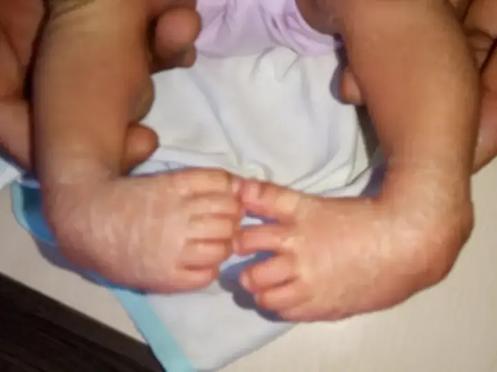 Clubfoot correction — before and after