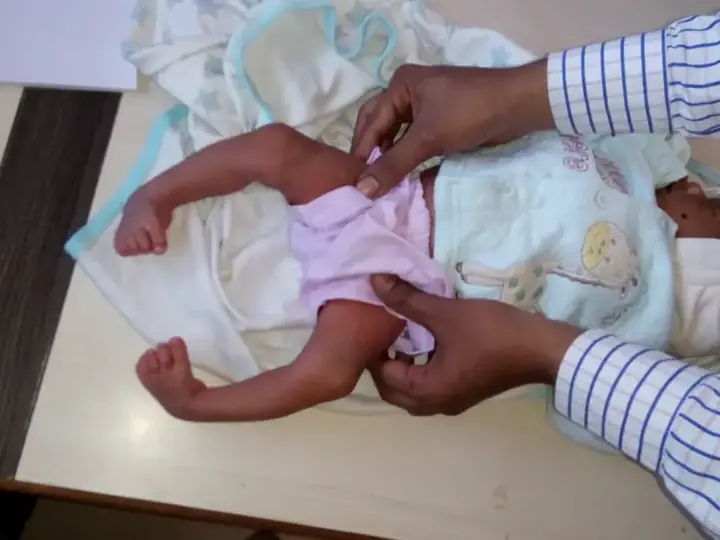 Clubfoot correction — before and after