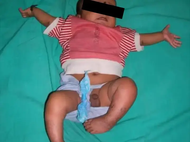 Clubfoot correction case
