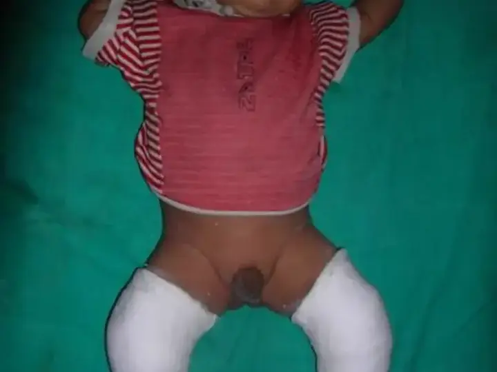 Clubfoot correction case