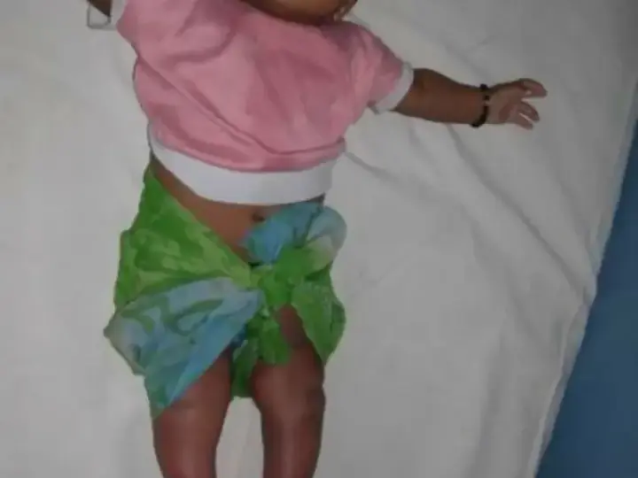 Clubfoot correction case