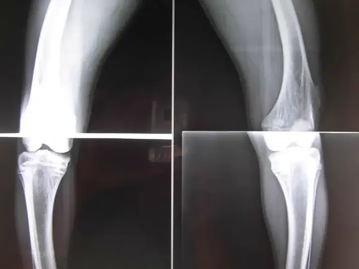 Deformity correction