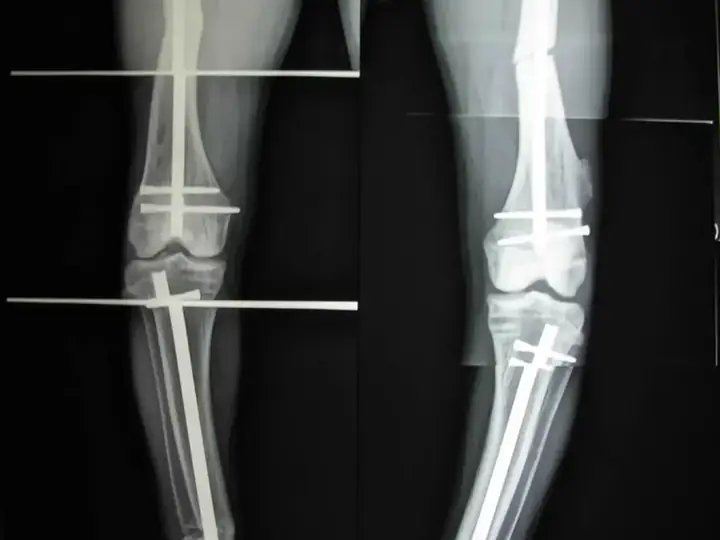 Deformity correction