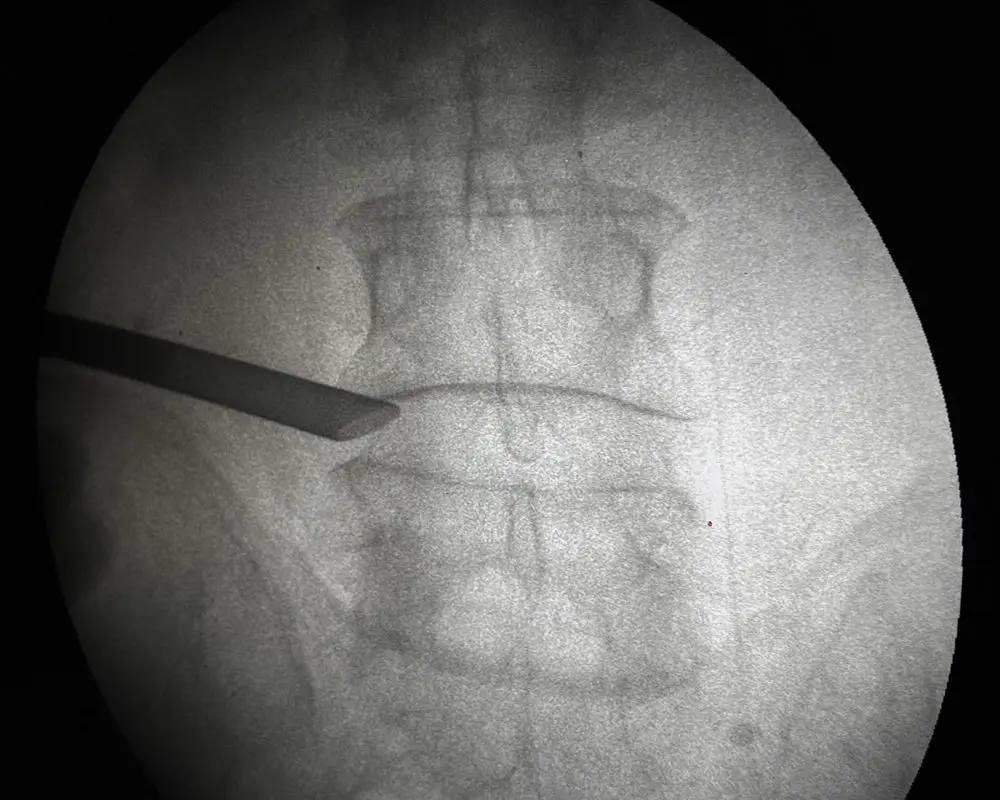 Endoscopic spine procedure under imaging