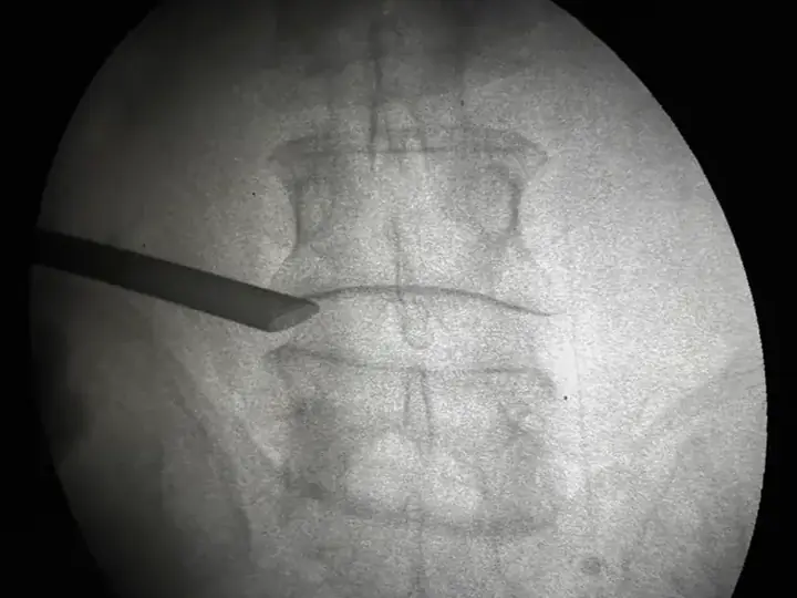 Endoscopic discectomy