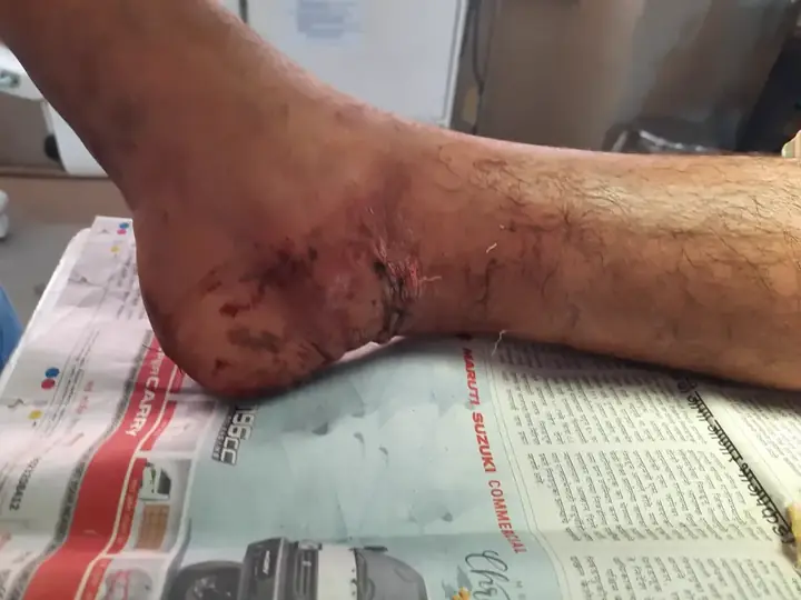 Farm injury treatment