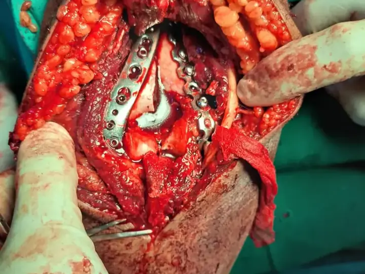 Elbow fracture treatment