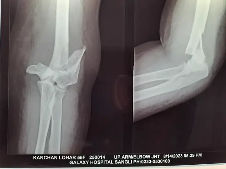 Elbow fracture treatment