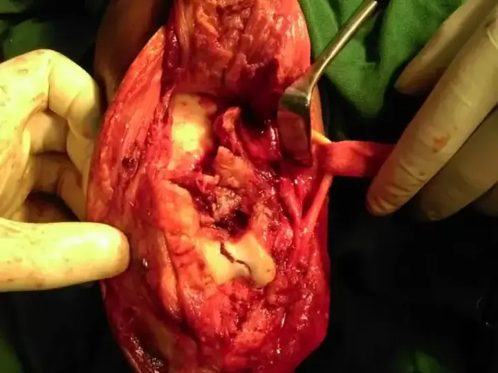 Elbow fracture treatment