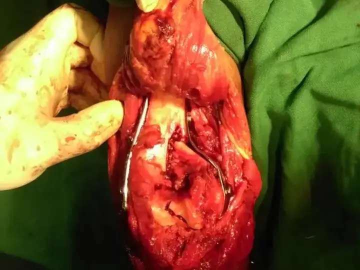 Elbow fracture treatment