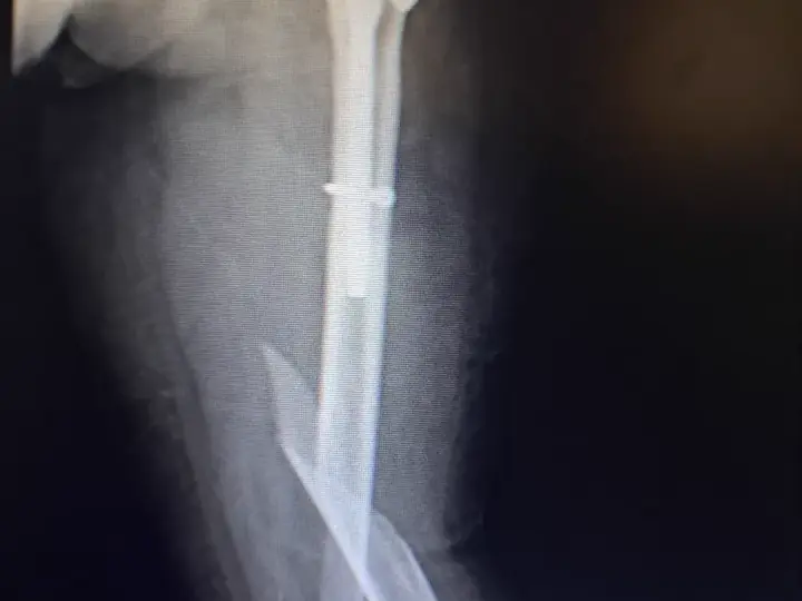 Femur fracture treatment