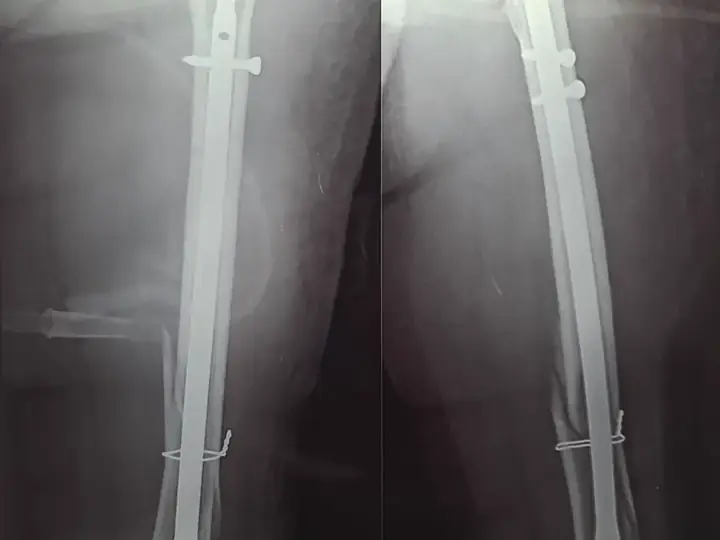 Femur fracture treatment