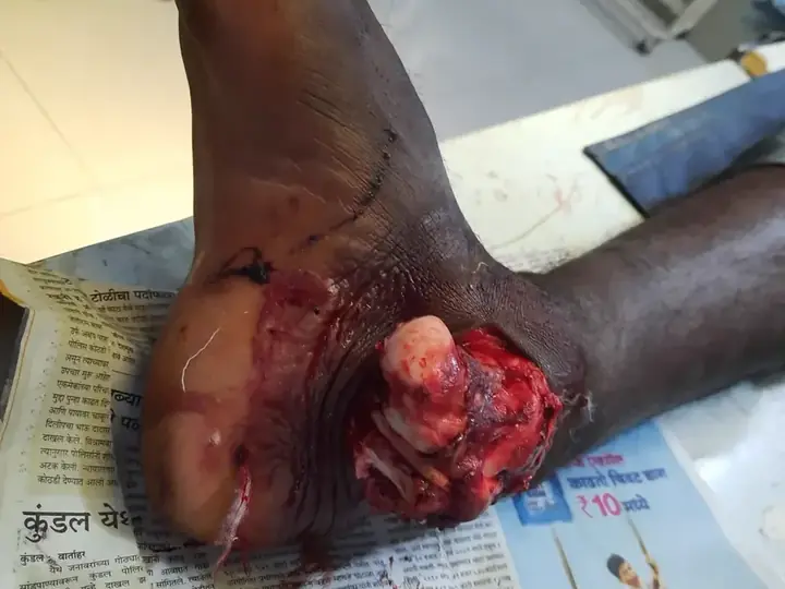 Subtalar dislocation treatment