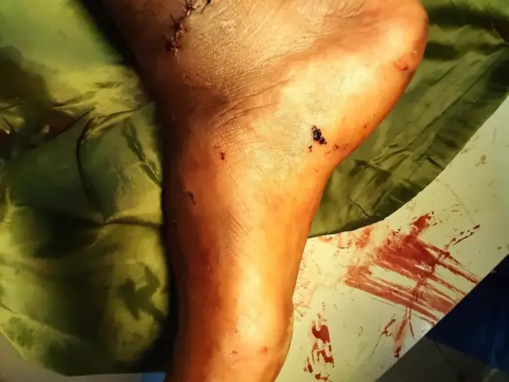 Subtalar dislocation treatment