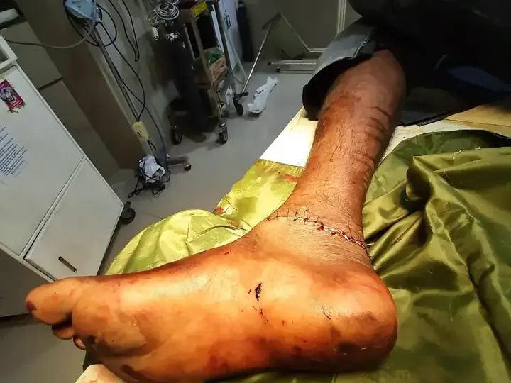 Subtalar dislocation treatment