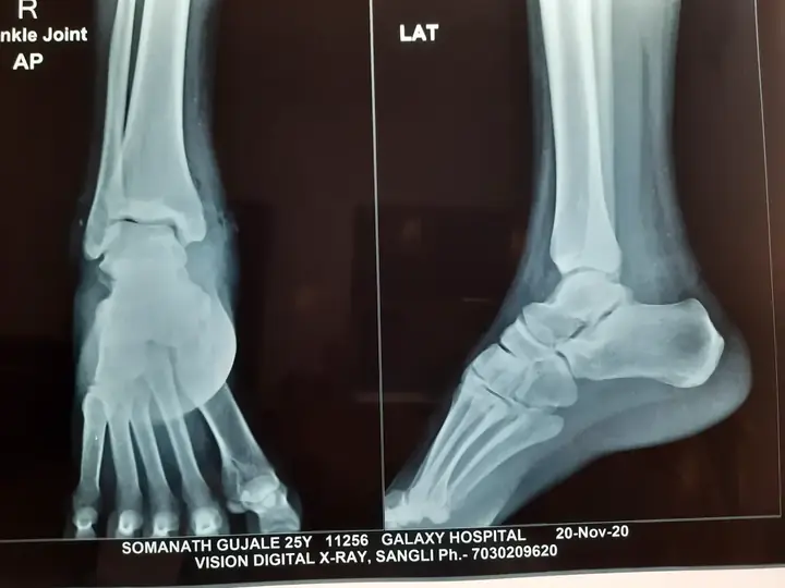 Subtalar dislocation treatment