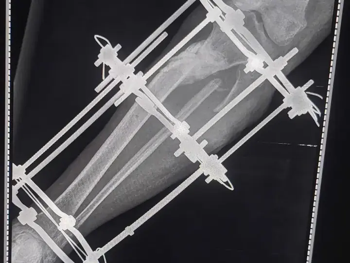 Tibia fracture treatment