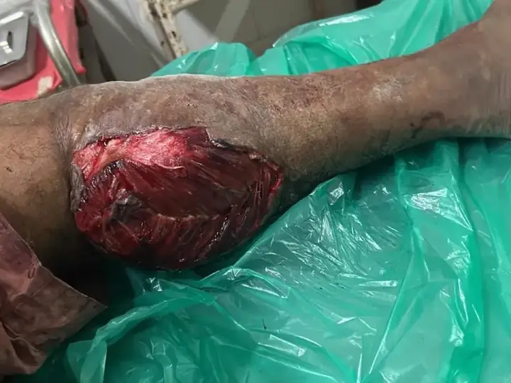 Tibia fracture treatment