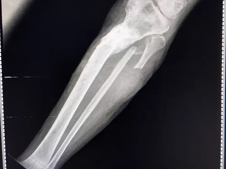 Tibia fracture treatment