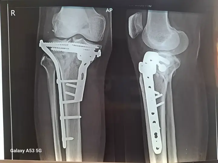 Tibia fracture treatment