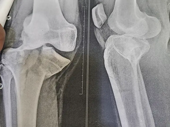 Tibia fracture treatment
