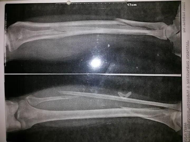 Lower tibia — MIPPO technique
