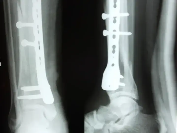 Lower tibia — MIPPO technique