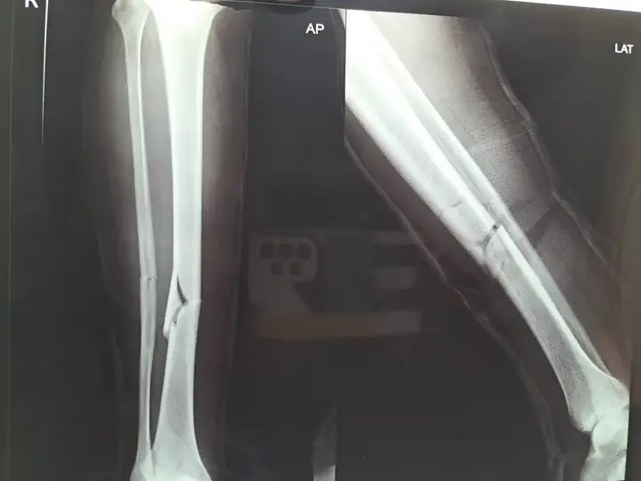 Tibia fracture — plaster treatment