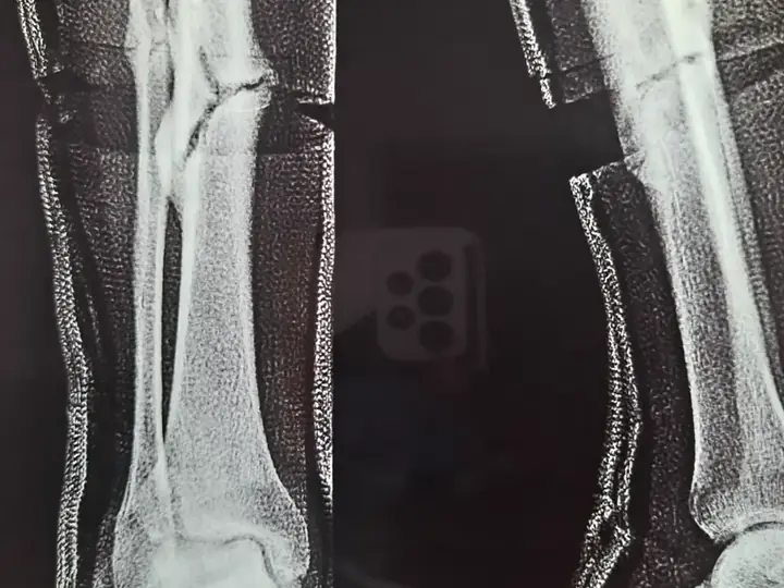 Tibia fracture — plaster treatment