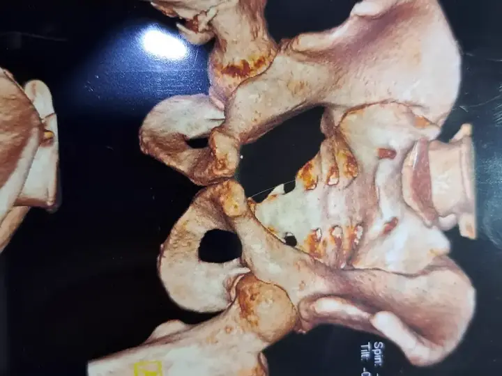 Trochanteric fracture treatment