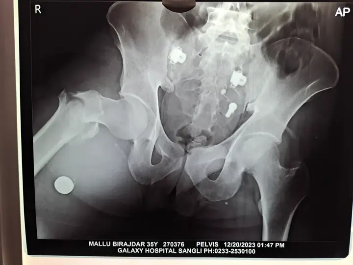 Trochanteric fracture treatment