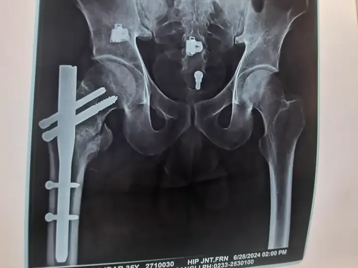 Trochanteric fracture treatment