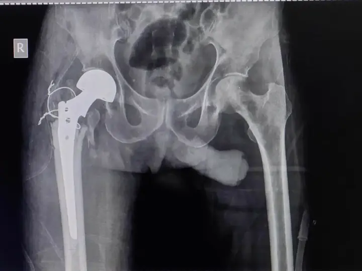 Comminuted trochanteric fracture