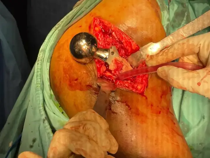 Comminuted trochanteric fracture