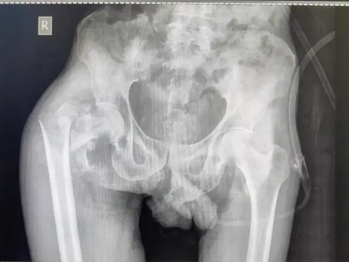 Comminuted trochanteric fracture