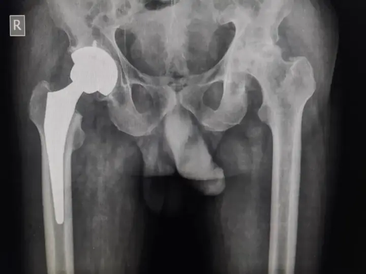 Hip replacement X-ray