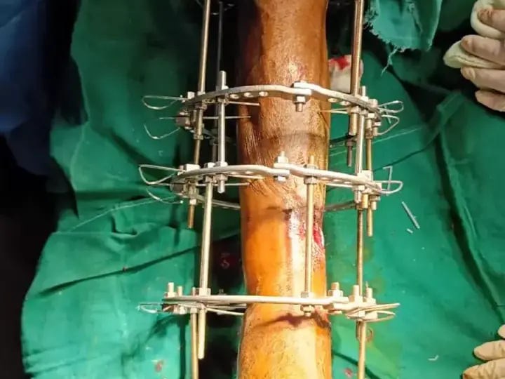 Ilizarov treatment