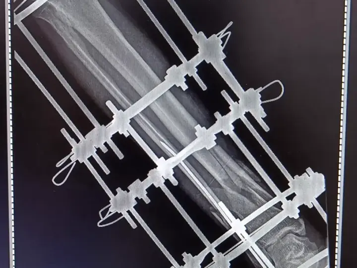 Ilizarov treatment