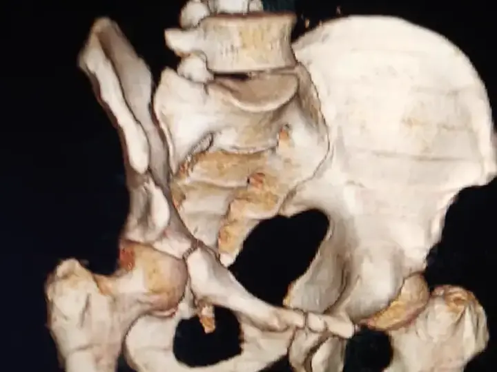Acetabulum fracture